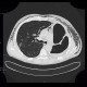 Pneumonectomy, hematoma of the pleural cavity, subcutaneous emphysema: CT - Computed tomography